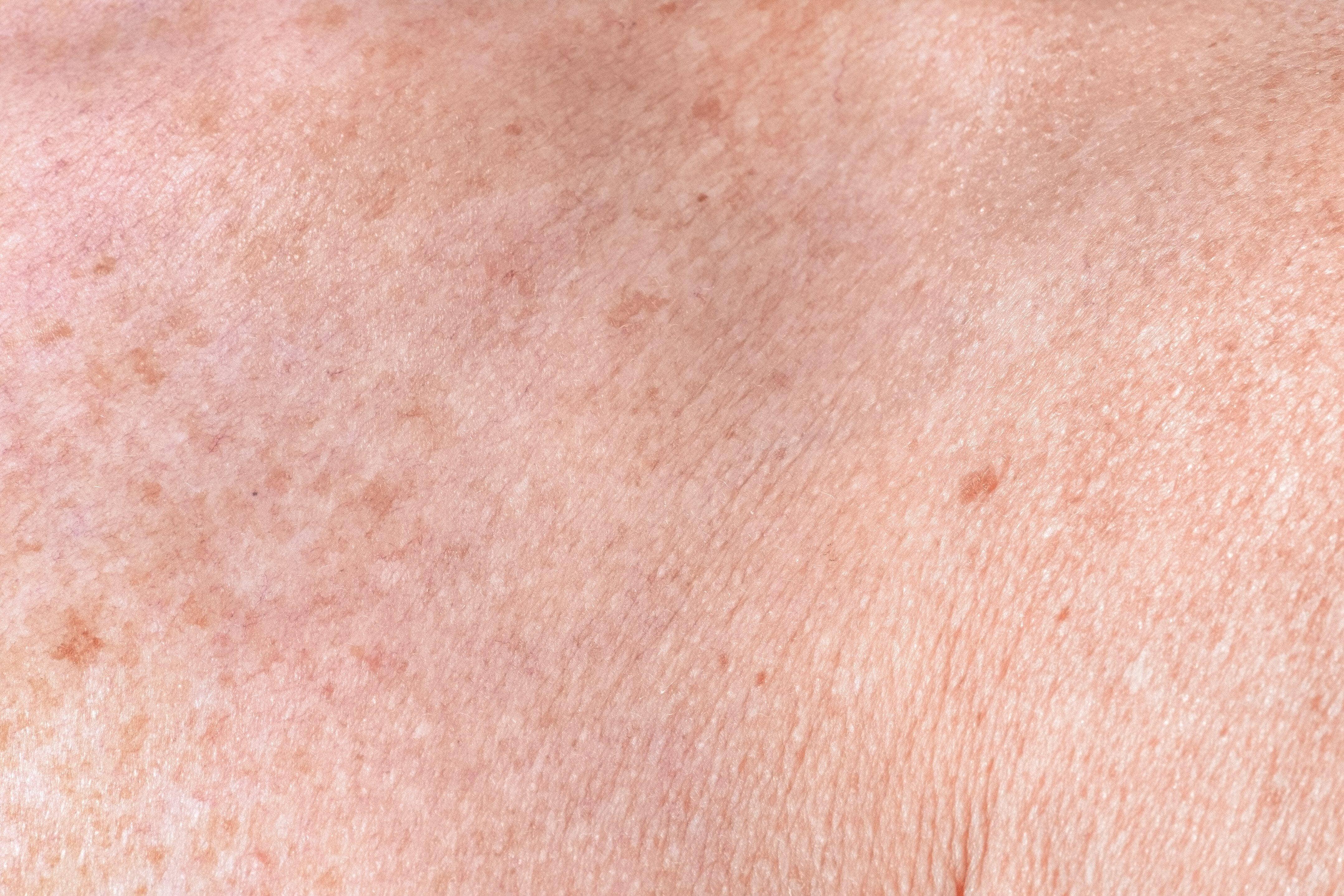 Wat is pigmentatie en hoe ontstaat het? - Skin / Scent