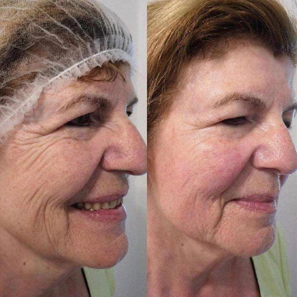 4D-Hifu Facelift (zonder naalden) - Skin / Scent