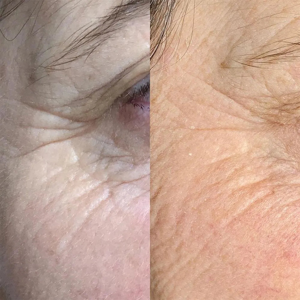 4D-Hifu Facelift (zonder naalden) - Skin / Scent