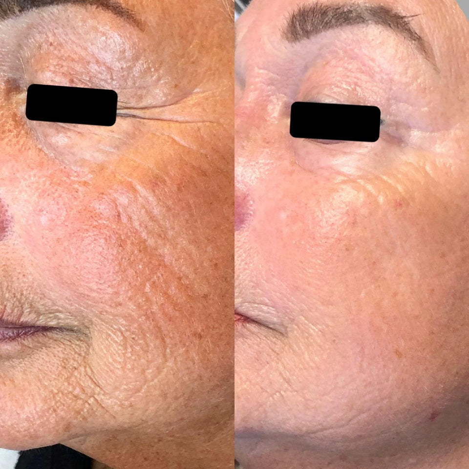 4D-Hifu Facelift (zonder naalden) - Skin / Scent