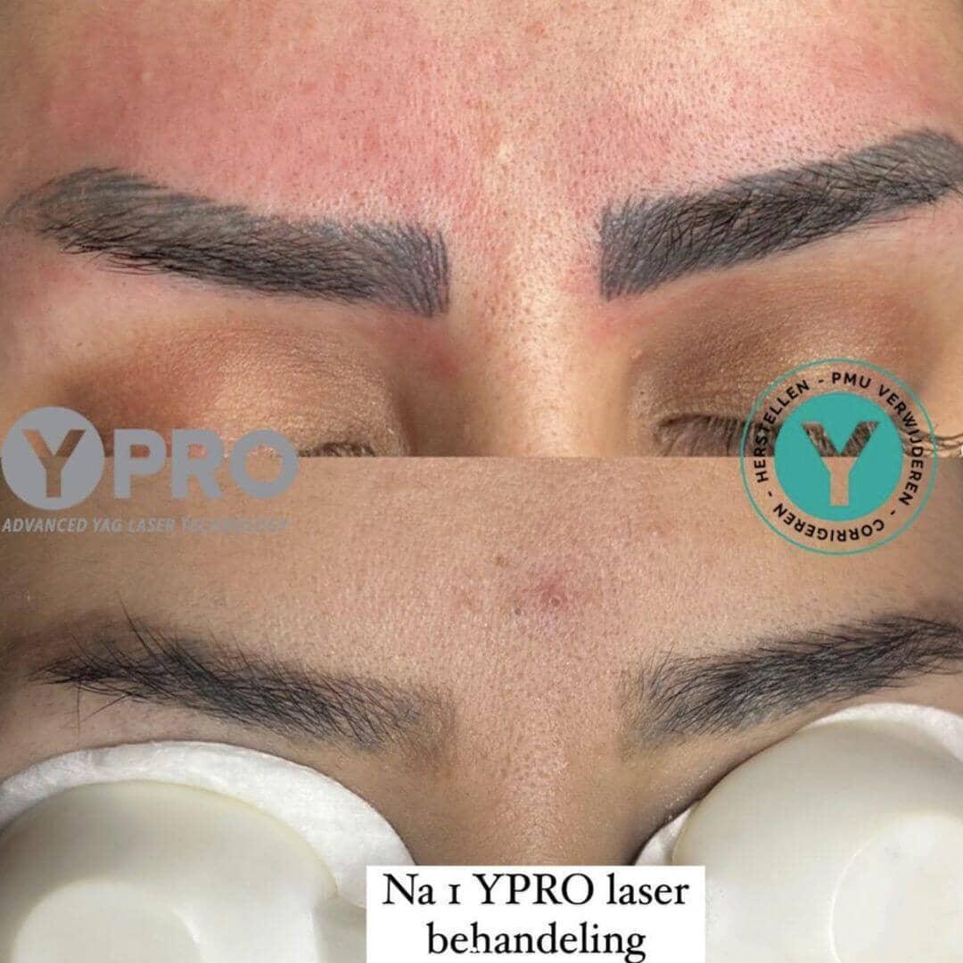 PMU of tatoeage verwijderen - Skin / Scent